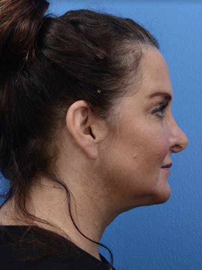 Facelift Before & After Gallery - Patient 19073000 - Image 4