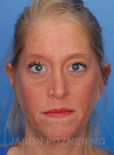 Blepharoplasty Before & After Gallery - Patient 23368272 - Image 1