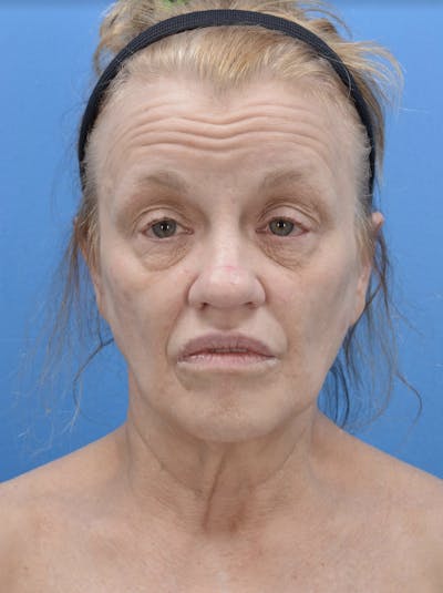 Facelift Before & After Gallery - Patient 19073006 - Image 1