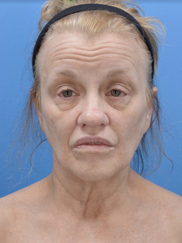 Facelift Before & After Gallery - Patient 19073006 - Image 1