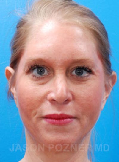 Blepharoplasty Before & After Gallery - Patient 23368272 - Image 2