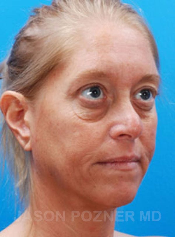 Blepharoplasty Before & After Gallery - Patient 23368272 - Image 3