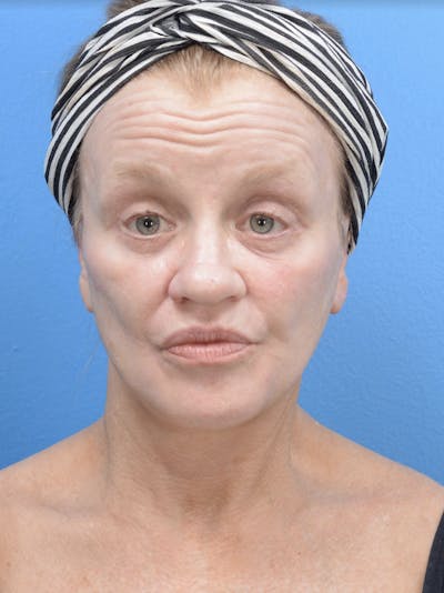 Facelift Before & After Gallery - Patient 19073006 - Image 2