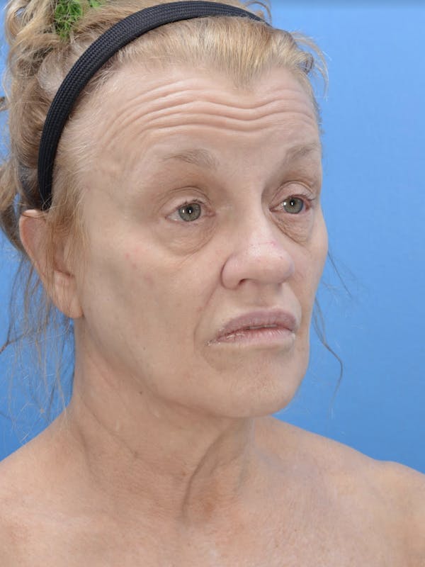 Facelift Before & After Gallery - Patient 19073006 - Image 3
