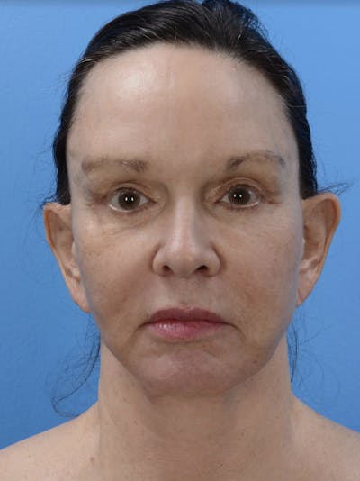 HALO™ Laser Before & After Gallery - Patient 19073007 - Image 1