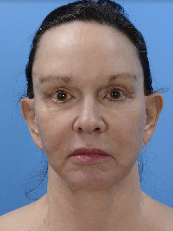 HALO™ Laser Before & After Gallery - Patient 19073007 - Image 1
