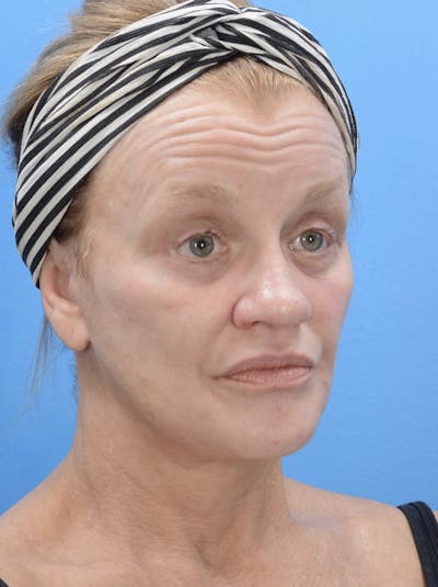 Facelift Before & After Gallery - Patient 19073006 - Image 4