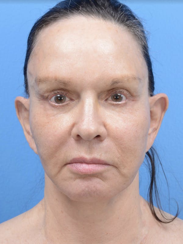HALO™ Laser Before & After Gallery - Patient 19073007 - Image 2