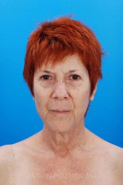 Facelift Before & After Gallery - Patient 19073008 - Image 1