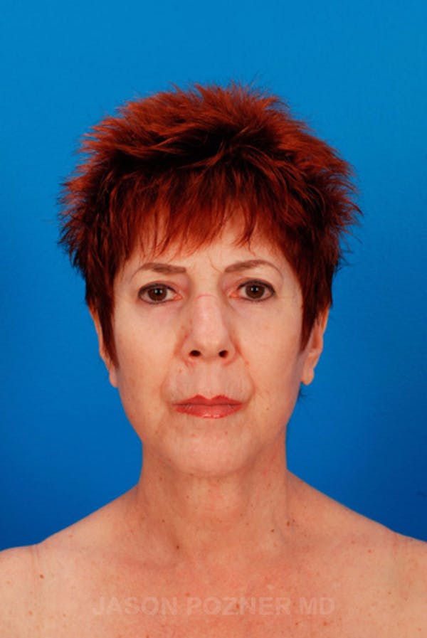 Facelift Before & After Gallery - Patient 19073008 - Image 2