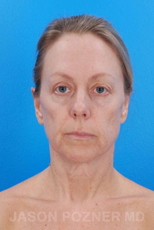 Facelift Before & After Gallery - Patient 19073010 - Image 1