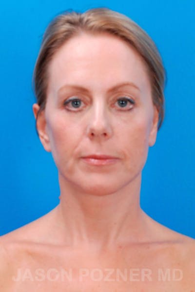 Facelift Before & After Gallery - Patient 19073010 - Image 2
