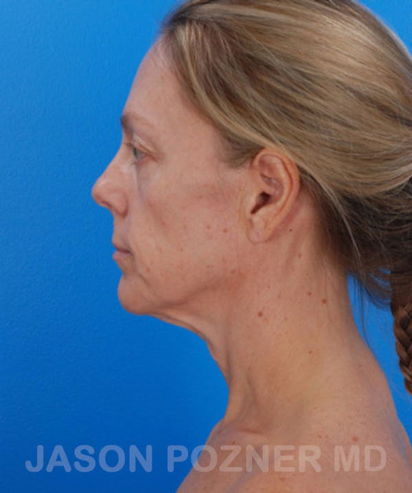 Facelift Before & After Gallery - Patient 19073010 - Image 3