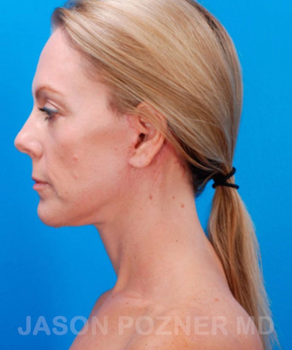 Facelift Before & After Gallery - Patient 19073010 - Image 4