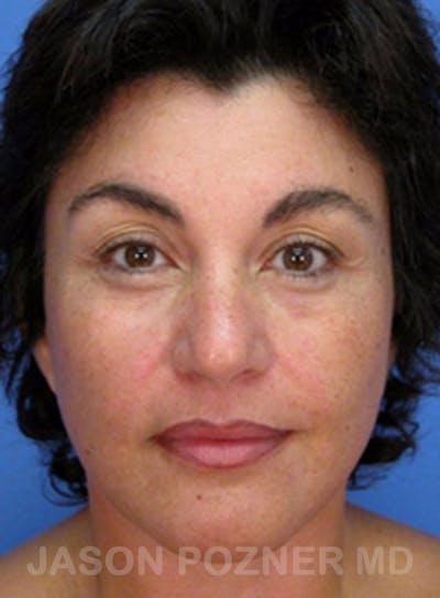 Facelift Before & After Gallery - Patient 19073013 - Image 1