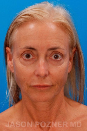 Facelift in Boca Raton & West Palm Beach Before & After Photos