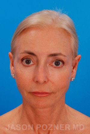 Facelift in Boca Raton & West Palm Beach Before & After Photos