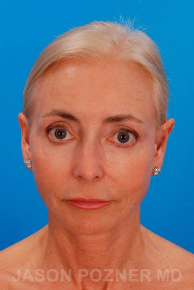 Facelift Before & After Gallery - Patient 19073015 - Image 2