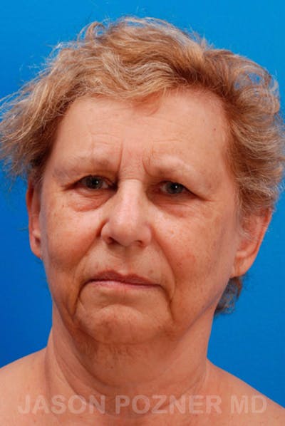 Facelift Before & After Gallery - Patient 19073018 - Image 1
