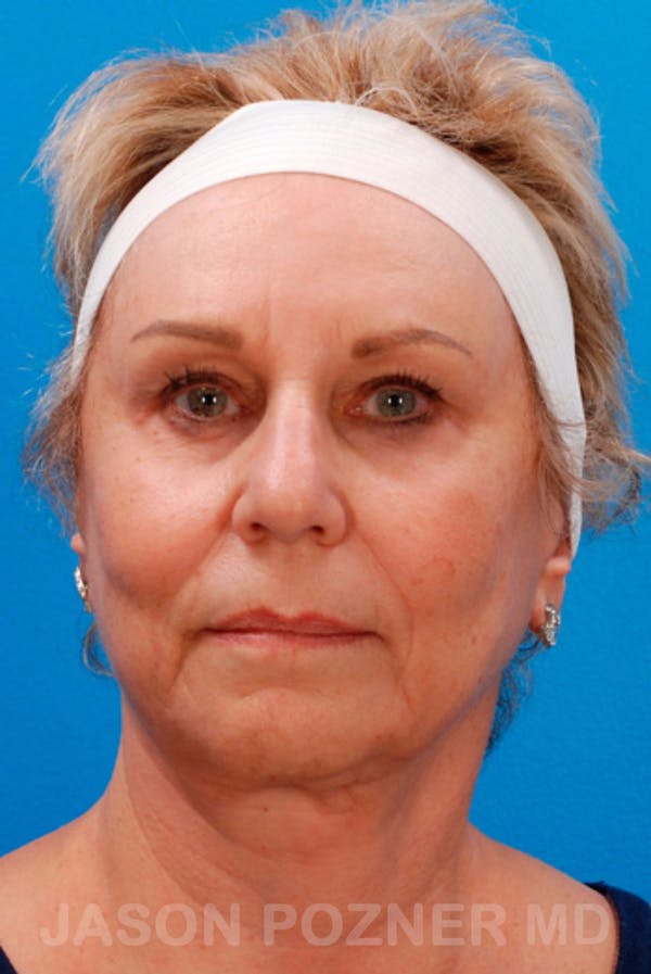 Facelift Before & After Gallery - Patient 19073018 - Image 2