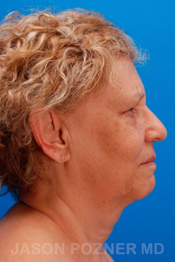 Facelift Before & After Gallery - Patient 19073018 - Image 3