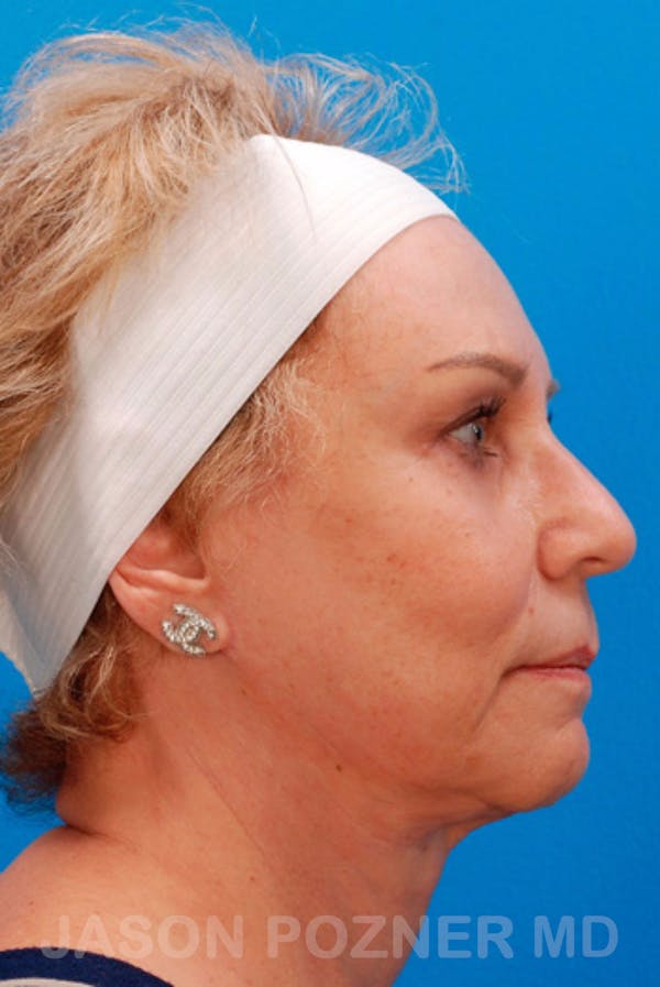 Facelift Before & After Gallery - Patient 19073018 - Image 4