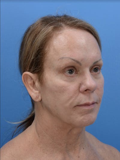 Neck Lift Before & After Gallery - Patient 19073686 - Image 1