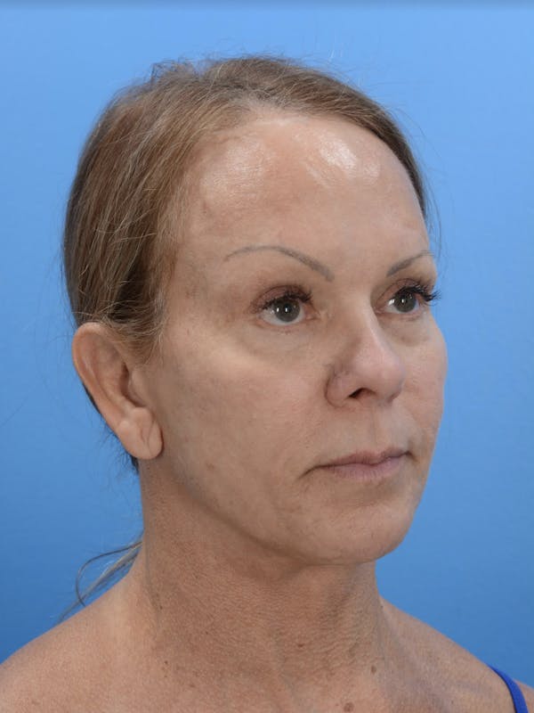 Neck Lift Before & After Gallery - Patient 19073686 - Image 2