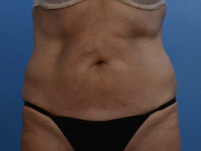 BodyTite & Renuvion Before & After Gallery - Patient 26207459 - Image 2