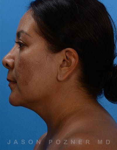 FaceTite Before & After Gallery - Patient 19074376 - Image 1
