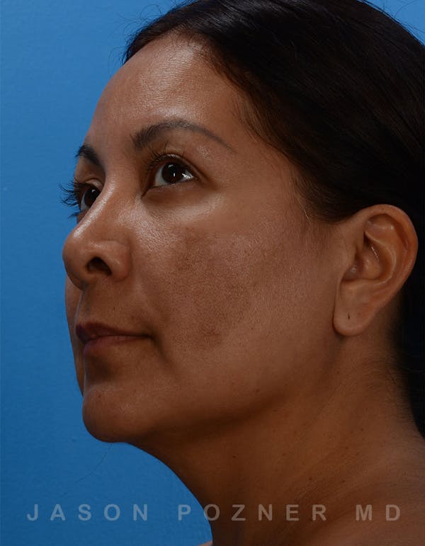 FaceTite Before & After Gallery - Patient 19074376 - Image 3