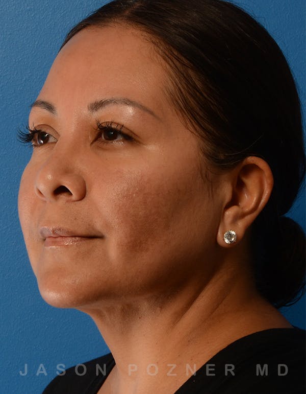 FaceTite Before & After Gallery - Patient 19074376 - Image 4