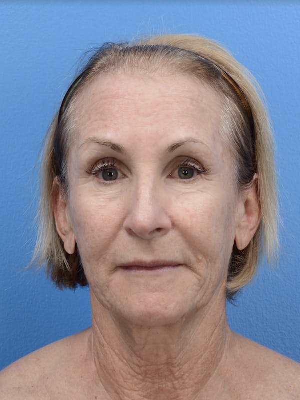 Laser Resurfacing Before & After Gallery - Patient 19074398 - Image 1