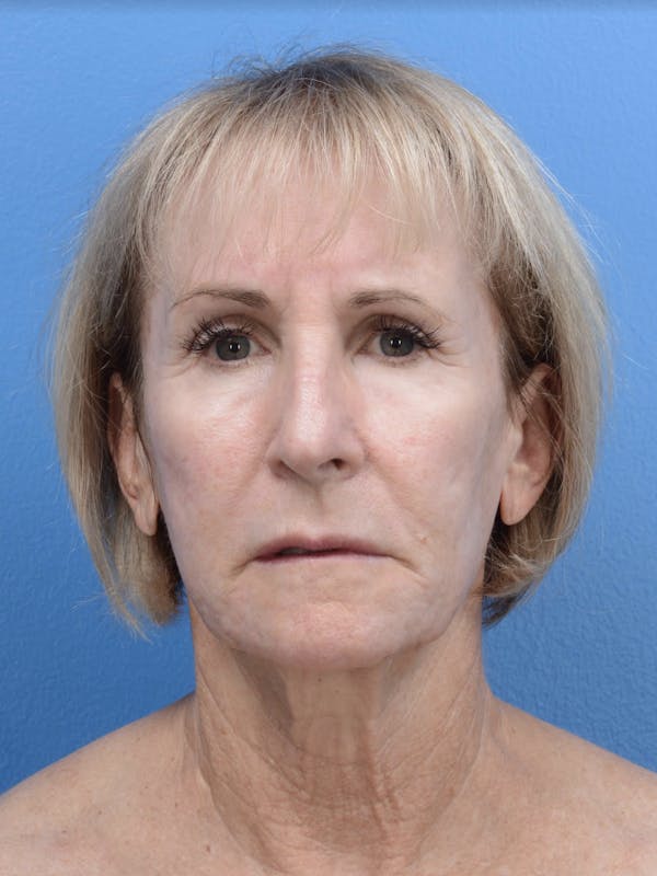 Laser Resurfacing Before & After Gallery - Patient 19074398 - Image 2