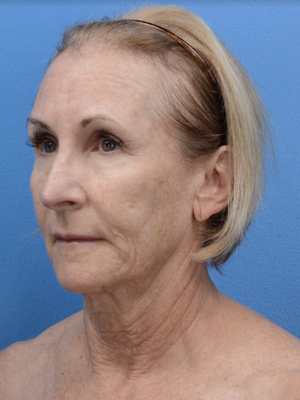 Laser Resurfacing Before & After Gallery - Patient 19074398 - Image 3