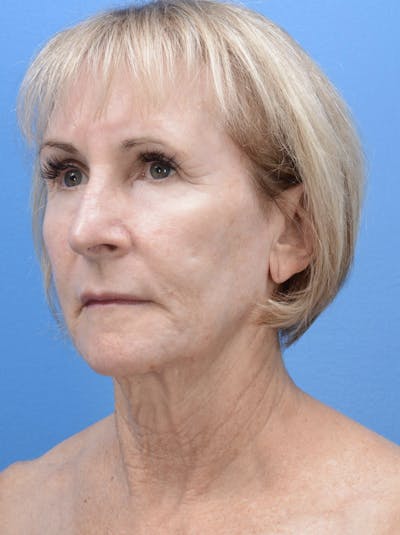 Laser Resurfacing Before & After Gallery - Patient 19074398 - Image 4