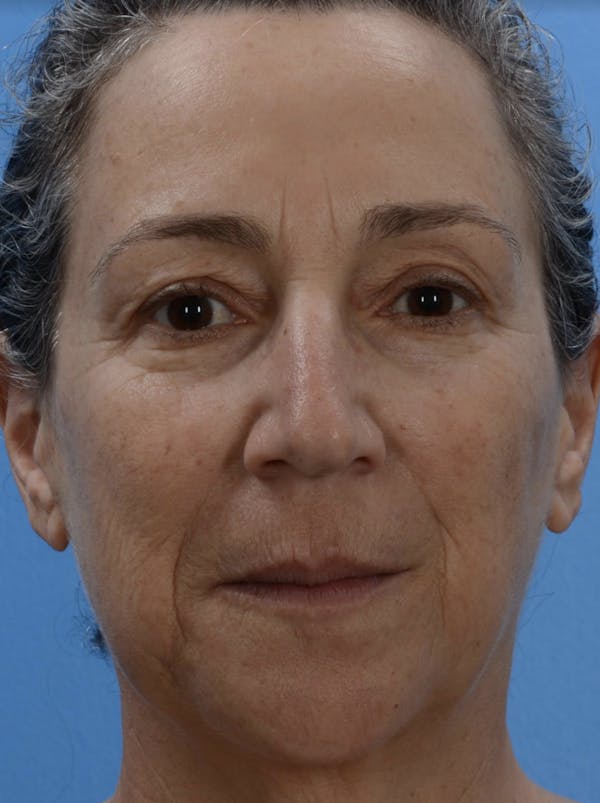 Laser Resurfacing Before & After Gallery - Patient 19074400 - Image 1