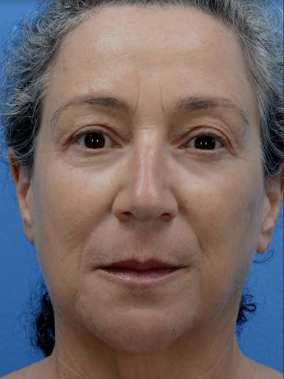 Laser Resurfacing Before & After Gallery - Patient 19074400 - Image 2