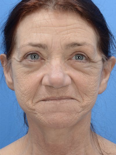 Laser Resurfacing Before & After Gallery - Patient 19074401 - Image 1
