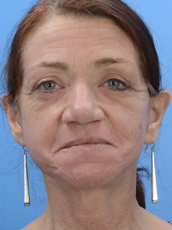Laser Resurfacing Before & After Gallery - Patient 19074401 - Image 2