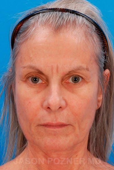 Laser Resurfacing Before & After Gallery - Patient 19074402 - Image 1