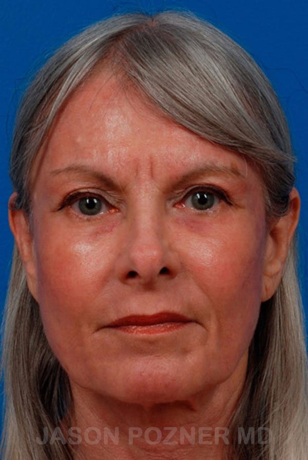 Laser Resurfacing Before & After Gallery - Patient 19074402 - Image 2
