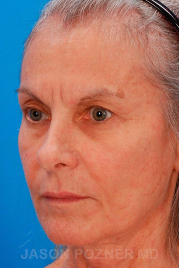 Laser Resurfacing Before & After Gallery - Patient 19074402 - Image 3