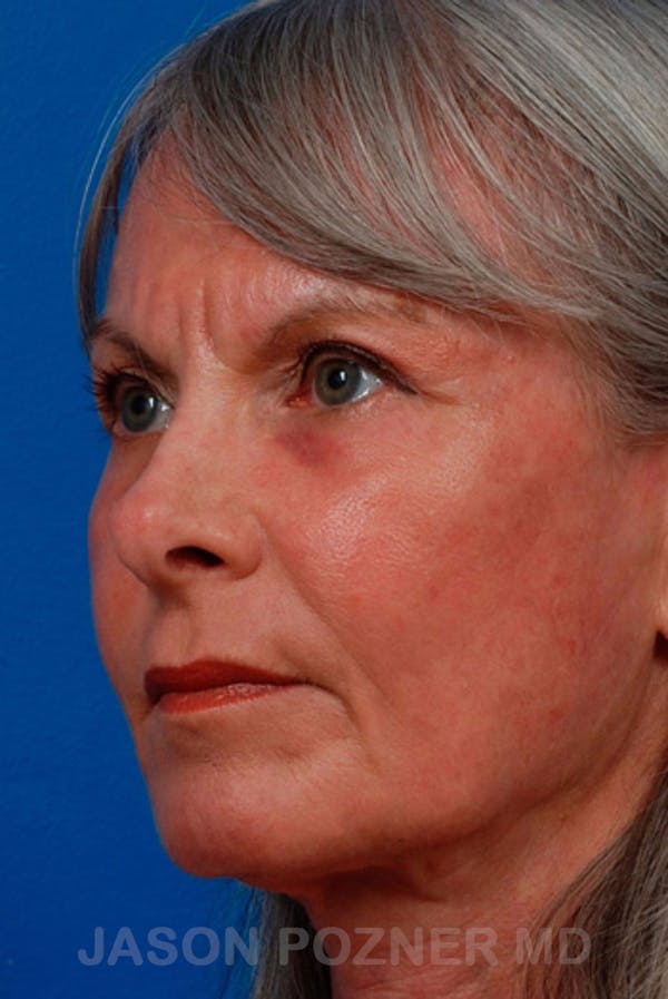Laser Resurfacing Before & After Gallery - Patient 19074402 - Image 4