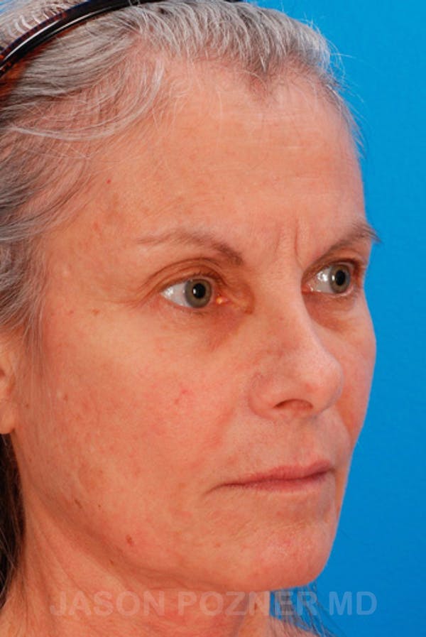 Laser Resurfacing Before & After Gallery - Patient 19074402 - Image 5