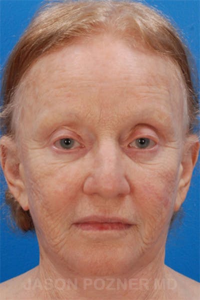 Laser Resurfacing Before & After Gallery - Patient 19074403 - Image 1