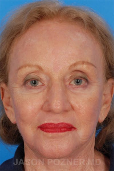 Laser Resurfacing Before & After Gallery - Patient 19074403 - Image 2