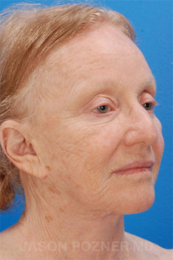 Laser Resurfacing Before & After Gallery - Patient 19074403 - Image 3
