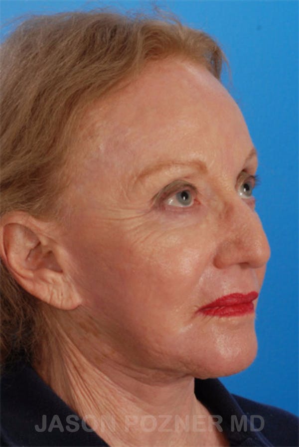 Laser Resurfacing Before & After Gallery - Patient 19074403 - Image 4