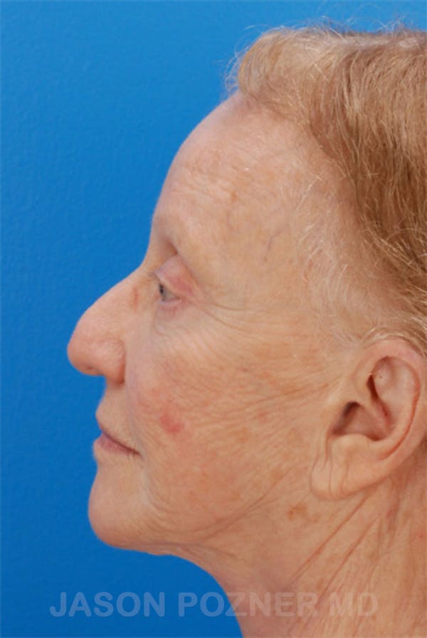 Laser Resurfacing Before & After Gallery - Patient 19074403 - Image 5